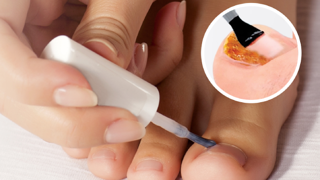 Anti Hongo ToenailPlus: Elimina Hongos de Uñas de Manera Eficaz y Rápida